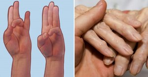 Развитие  полиартрита пальцев рук