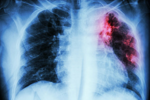 Туберкулез легких