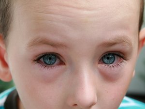 Появление аллергии на глазах