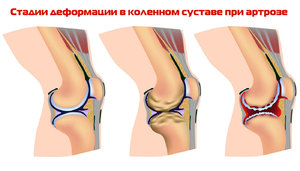Стадии деформации коленного сустава