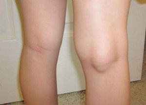 Гигрома коленного сустава: симптомы заболевания