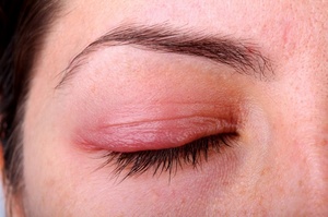 Аллергия на глаза может действовать thumbnail