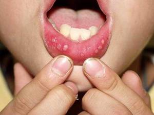 Особенности лечения стоматита у детей