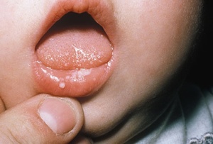 Лечение герпетического стоматита у детей