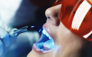 Показания к отбеливанию зубов в клинике
