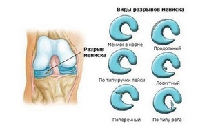Терапия патологий менисков коленных суставов
