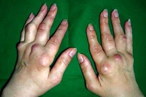 Как проявляется полиартрит рук
