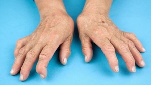 Лечение полиартрита рук