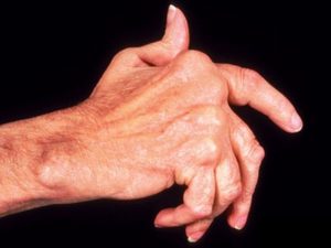 Мази для лечения полиартрита рук