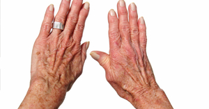 Диета при лечении полиартрита рук
